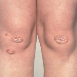 Example of psoriasis
